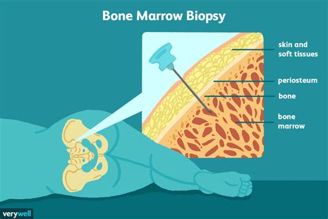 understanding bone marrow biopsy results|reasons for a bone marrow test.